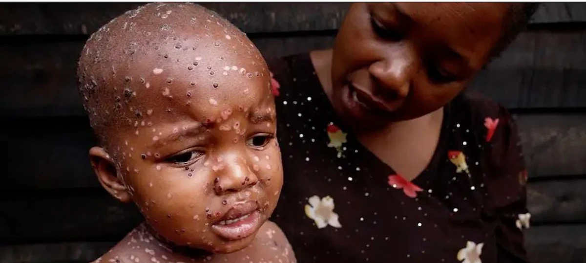 Mpox Outbreak 2024 in Congo: Key Facts and Insights on the Epidemic